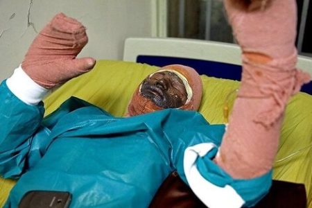 اقدامات اورژانسی در مواجهه با فردی که دچار سوختگی شده است