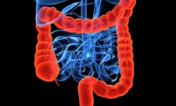 اینفوگرافیک / تشخیص زودهنگام سرطان روده با پنج علامت