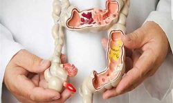 پولیپ روده چیست؟ بررسی علائم، دلایل، تشخیص و درمان