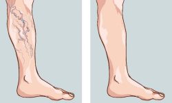 رگهای واریسی؛ عارضه جانبی شایع چاقی