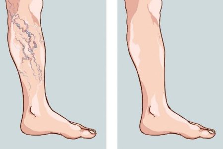 رگهای واریسی؛ عارضه جانبی شایع چاقی