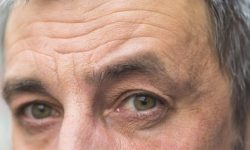 چین و چروک‌های صورت درباره کدام بیماری‌ها هشدار می‌دهند؟