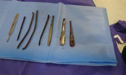 شوکه شدن پزشکان با دیدن ۴ دسته قاشق و ۴ شی فلزی در معده مرد شیشه‌ای