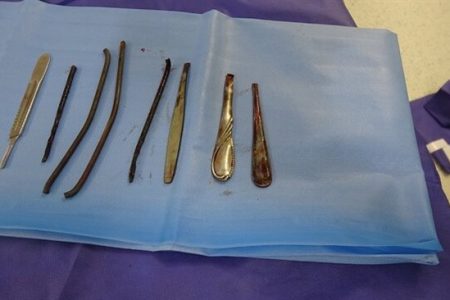 شوکه شدن پزشکان با دیدن ۴ دسته قاشق و ۴ شی فلزی در معده مرد شیشه‌ای