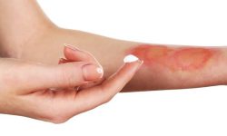 ترمیم سریع سوختگی با بانداژ ساخته‌شده از سیب، ذرت و سویا!