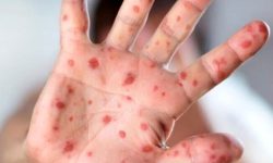 شیوع بیماری سرخک در عراق / تزریق واکسن سرخک قبل از سفر اربعین اجباری است؟