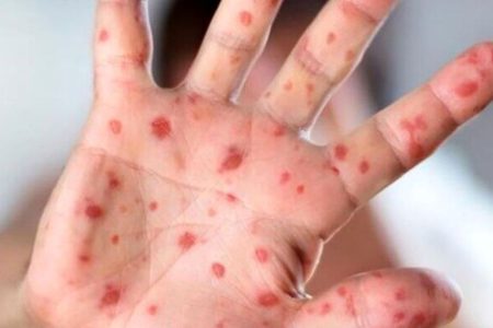 شیوع بیماری سرخک در عراق / تزریق واکسن سرخک قبل از سفر اربعین اجباری است؟