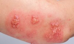 اگر آبله‌ مرغان گرفته اید، این بیماری تهدیدتان می‌ کند/ زونا را در خانه با این روش درمان کنید /علت ایجاد بیماری پوستی «زونا» چیست؟