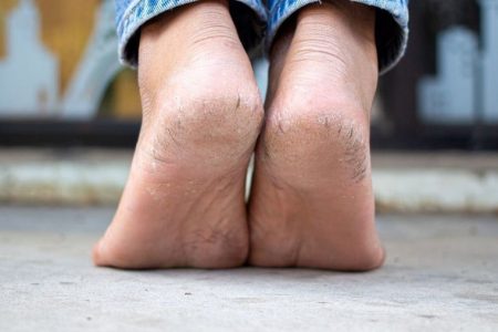 کمبود کدام ویتامین ها باعث پوسته شدن کف پا می شود ؟ / علت ترک پاشنه پا را بدانید/ درمان ترک پا با ۹ راهکار خانگی ساده