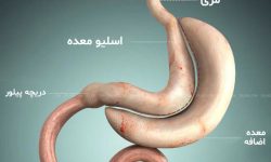 خطرات و مزایای جراحی اسلیو معده برای چاق‌ها / چه افرادی می‌توانند این جراحی را انجام دهند؟