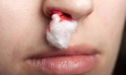شایع‌ترین علل خونریزی بینی؛ چه زمانی به پزشک مراجعه کنیم؟
