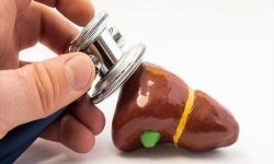 همه چیز درباره سنگ کیسه صفرا؛ چه زمانی به جراحی نیاز داریم؟