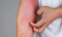 چگونه از شر خارش و التهاب در فصل بهار رها شویم؟