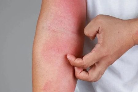 چگونه از شر خارش و التهاب در فصل بهار رها شویم؟