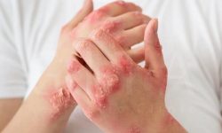 واقعیت پزشکی درباره بیماری مزمن پسوریازیس