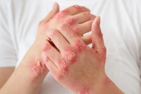 واقعیت پزشکی درباره بیماری مزمن پسوریازیس