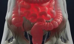 خونریزی گوارشی تحتانی؛ بواسیر یا سرطان؟