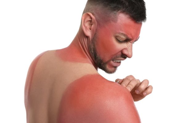 تنها یک آفتاب‌سوختگی شدید می‌تواند سلامت ما را برای همیشه تغییر دهد